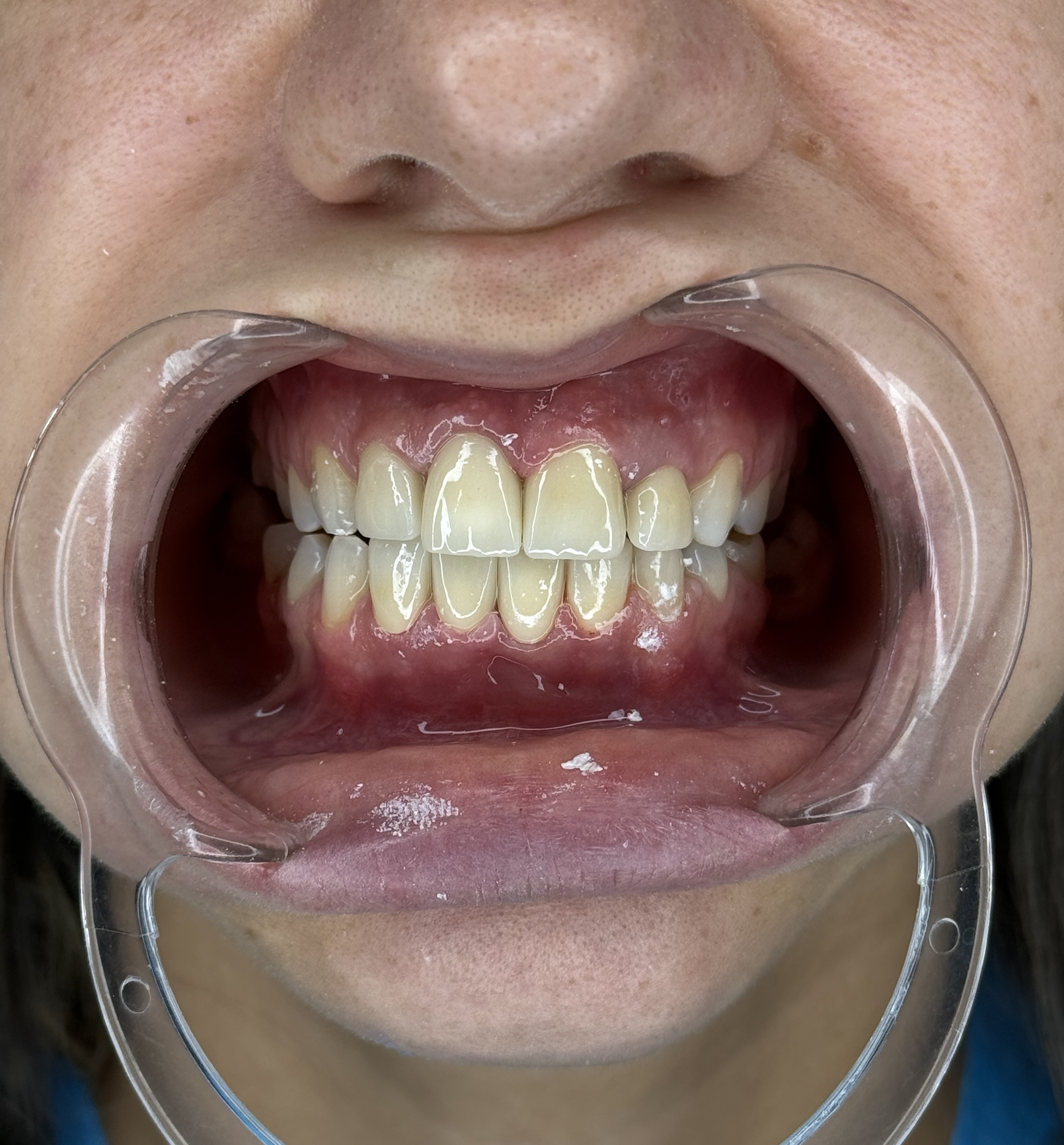 Композитне фасете, 21. март 2024, Дуњадент