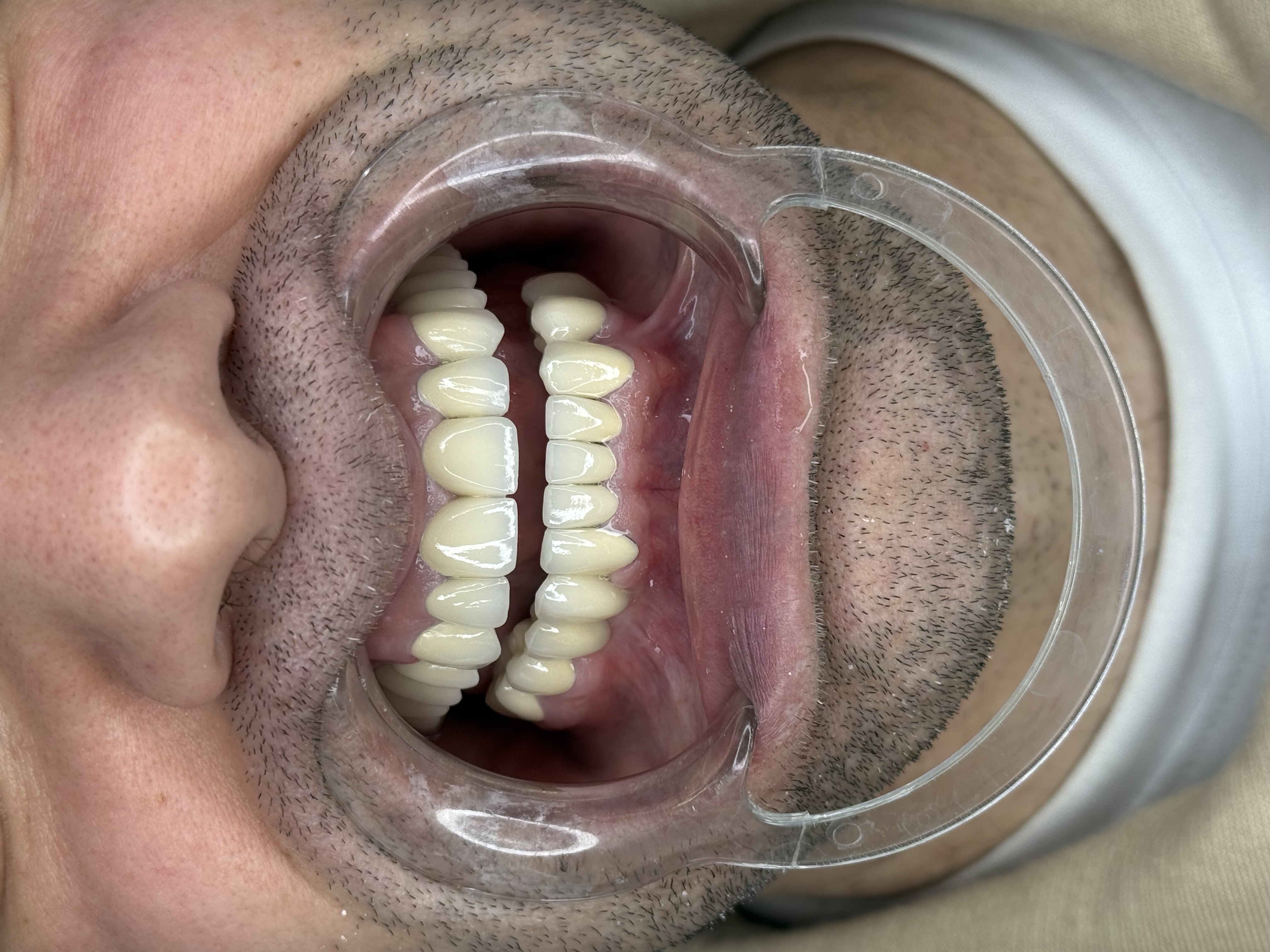 Композитне фасете, 21. март 2024, Дуњадент