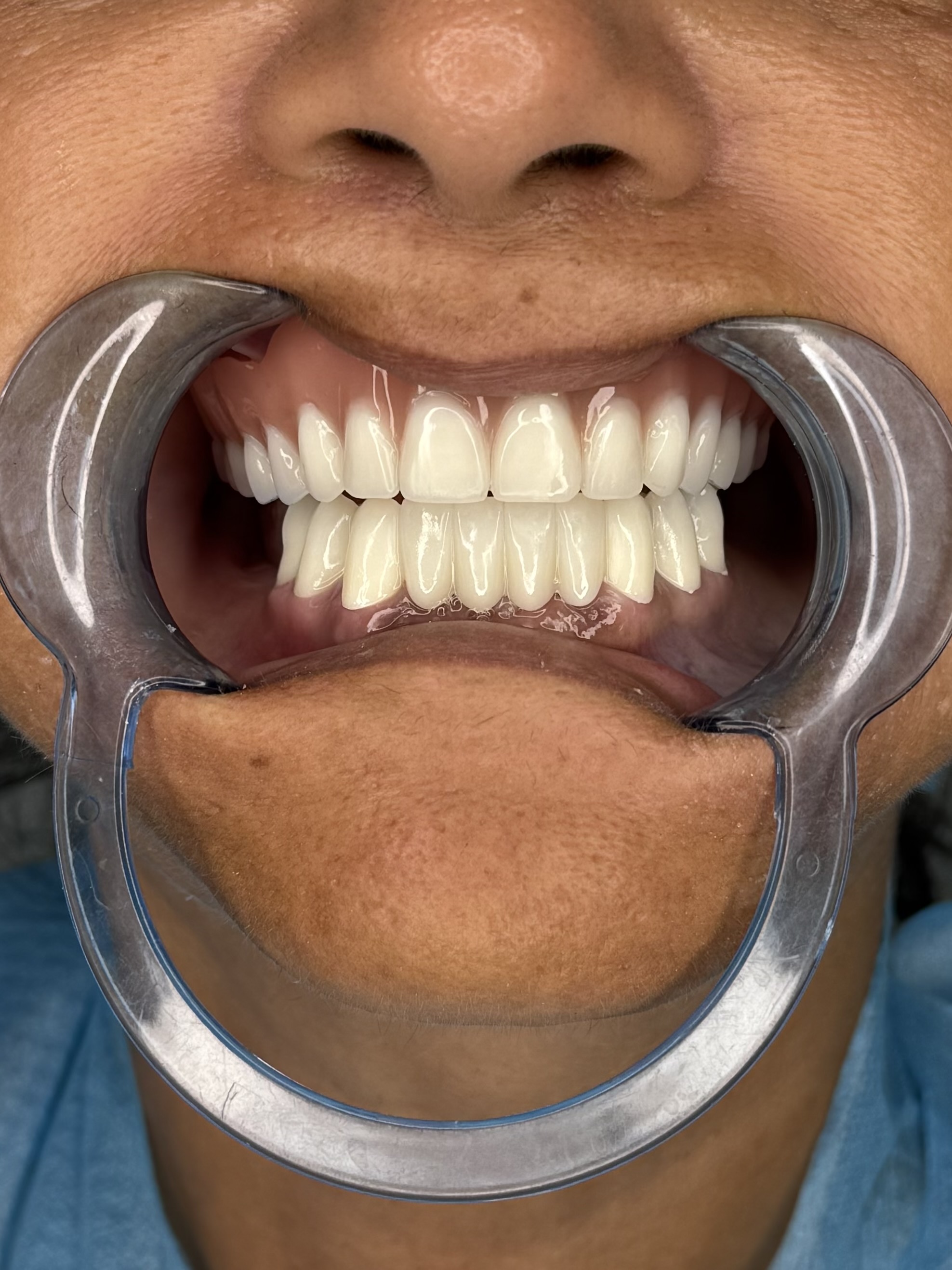 Композитне фасете, 21. март 2024, Дуњадент